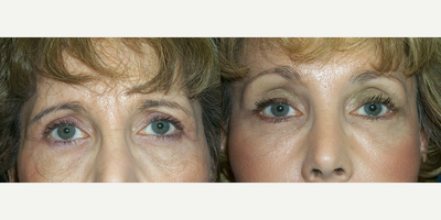Eyelid Surgery before and after photo