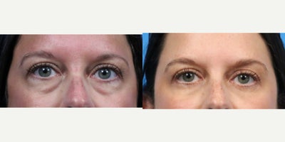 Eyelid Surgery before and after photo