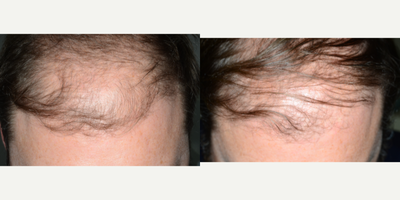 PRP for Hair Loss before and after photo