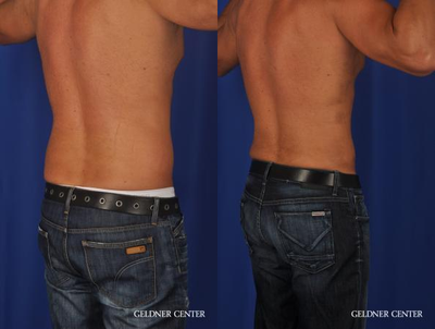 Vaser Liposuction before and after photo