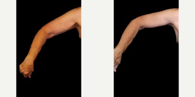 Arm Lift before and after photo