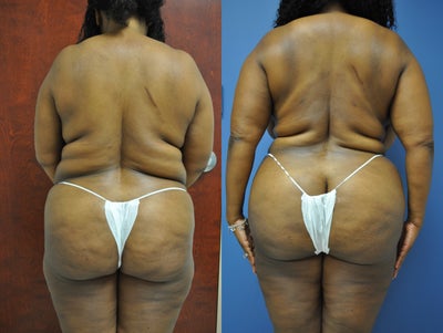 Brazilian Butt Lift before and after photo