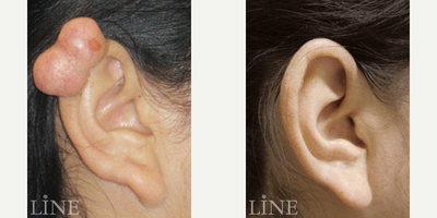 Ear Surgery before and after photo
