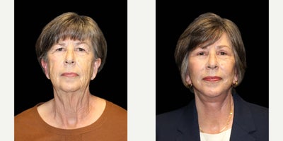 Facelift before and after photo