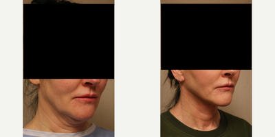 Neck Lift before and after photo