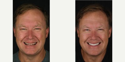 Porcelain Veneers before and after photo
