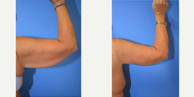 Arm Lift before and after photo