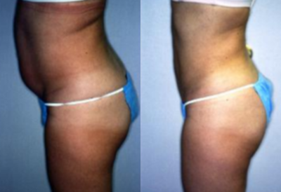 BodyTite before and after photo