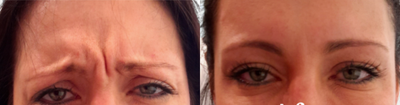 Botox before and after photo