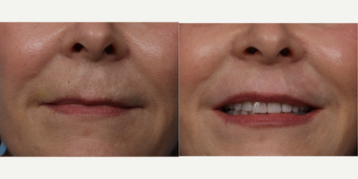 Chemical Peel before and after photo