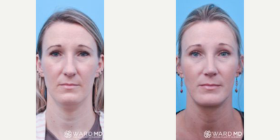 Chin Implant before and after photo