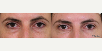 Dermal Fillers before and after photo