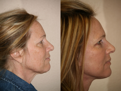 Facelift before and after photo