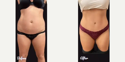 Tummy Tuck before and after photo