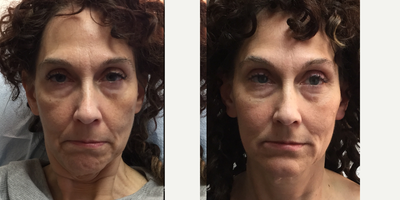 Dermal Fillers before and after photo