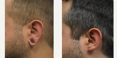 Earlobe Repair before and after photo
