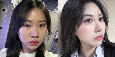 Liposuction before and after photo