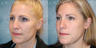 Rhinoplasty before and after photo