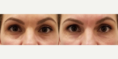Dermal Fillers before and after photo