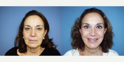 Facelift before and after photo