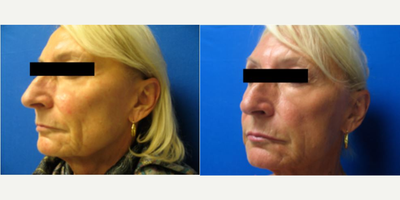 Sculptra before and after photo