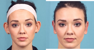 Ear Surgery before and after photo