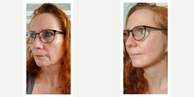 Facelift before and after photo