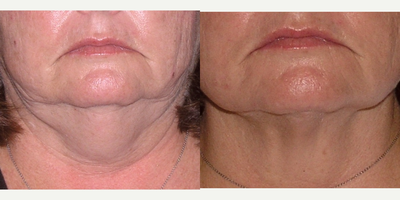 Liposuction before and after photo