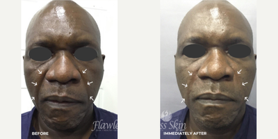 Dermal Fillers before and after photo