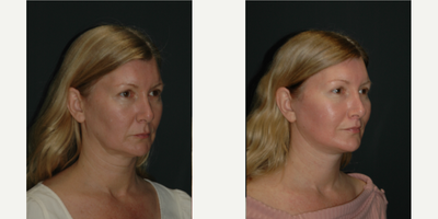 Facelift before and after photo