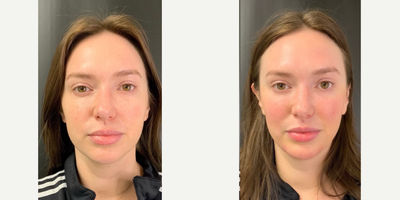 Juvederm before and after photo