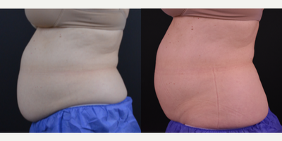 CoolSculpting before and after photo