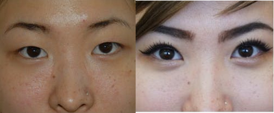Double Eyelid Surgery before and after photo