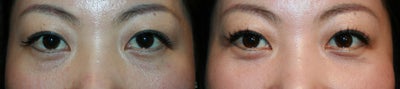 Eyelid Surgery before and after photo