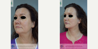 Facelift before and after photo