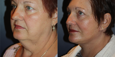 Facelift before and after photo