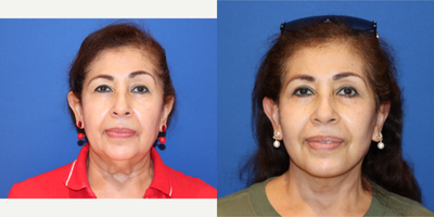 Facelift before and after photo