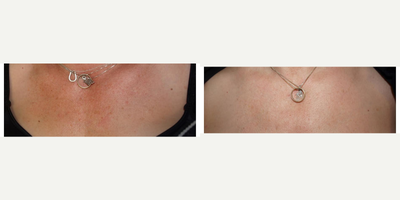 IPL before and after photo