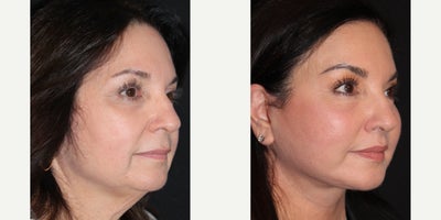 Lip Lift before and after photo