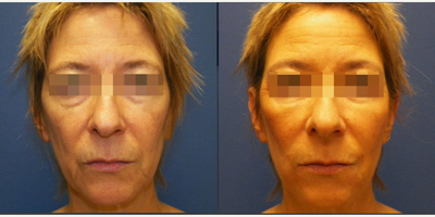Bellafill before and after photo