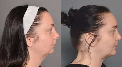 Chin Liposuction before and after photo