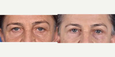 Eyelid Surgery before and after photo