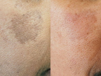 Laser Resurfacing before and after photo