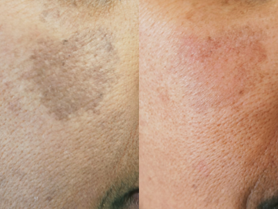 Laser Resurfacing before and after photo