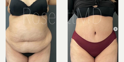 Liposuction before and after photo