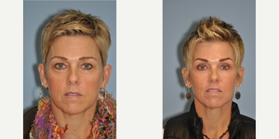 Laser Resurfacing before and after photo