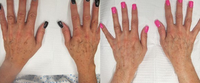 Laser Resurfacing before and after photo