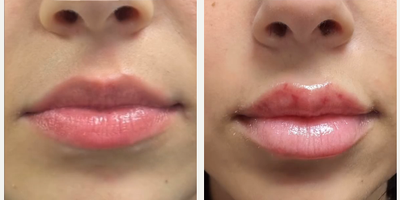 Lip Fillers before and after photo