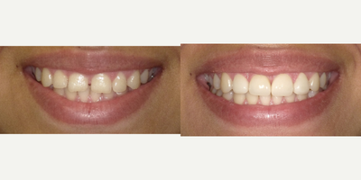 Porcelain Veneers before and after photo