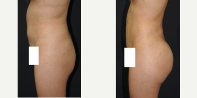 Brazilian Butt Lift before and after photo
